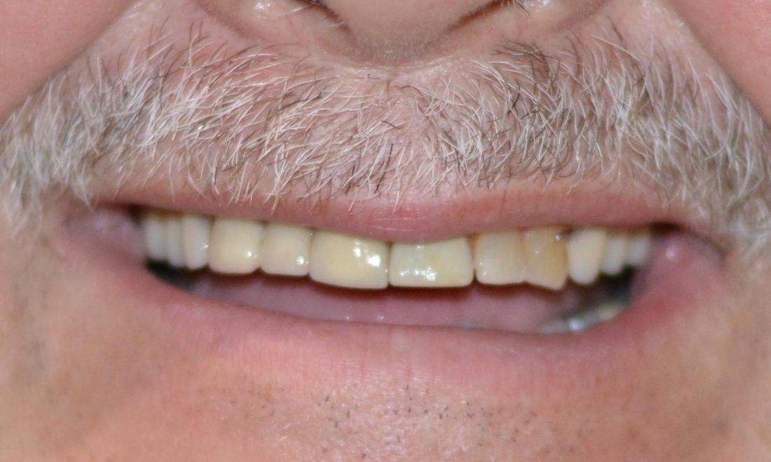 Bonita Grande Dental's Smile Gallery Crowns and Partial Denture