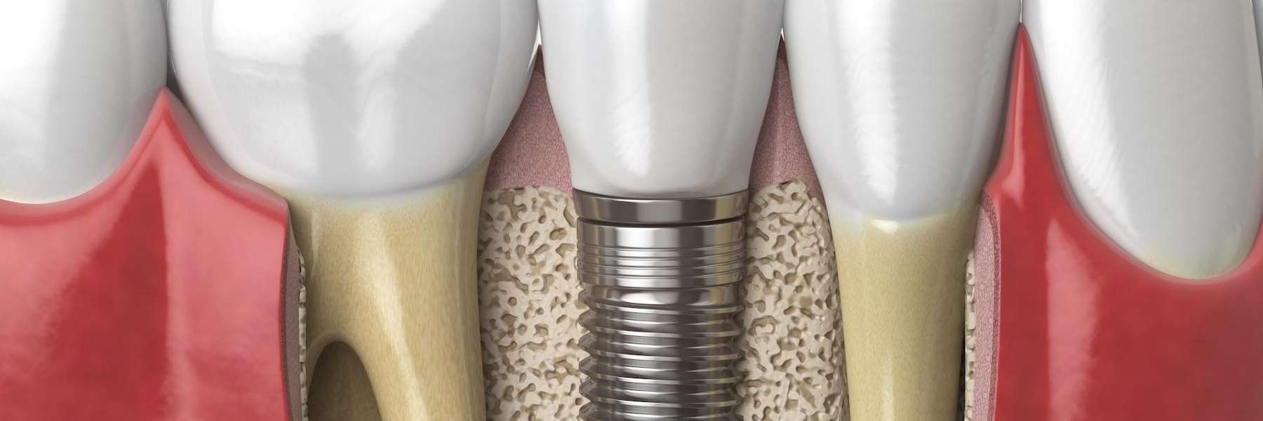 Dental implant in Bonita Lake FL