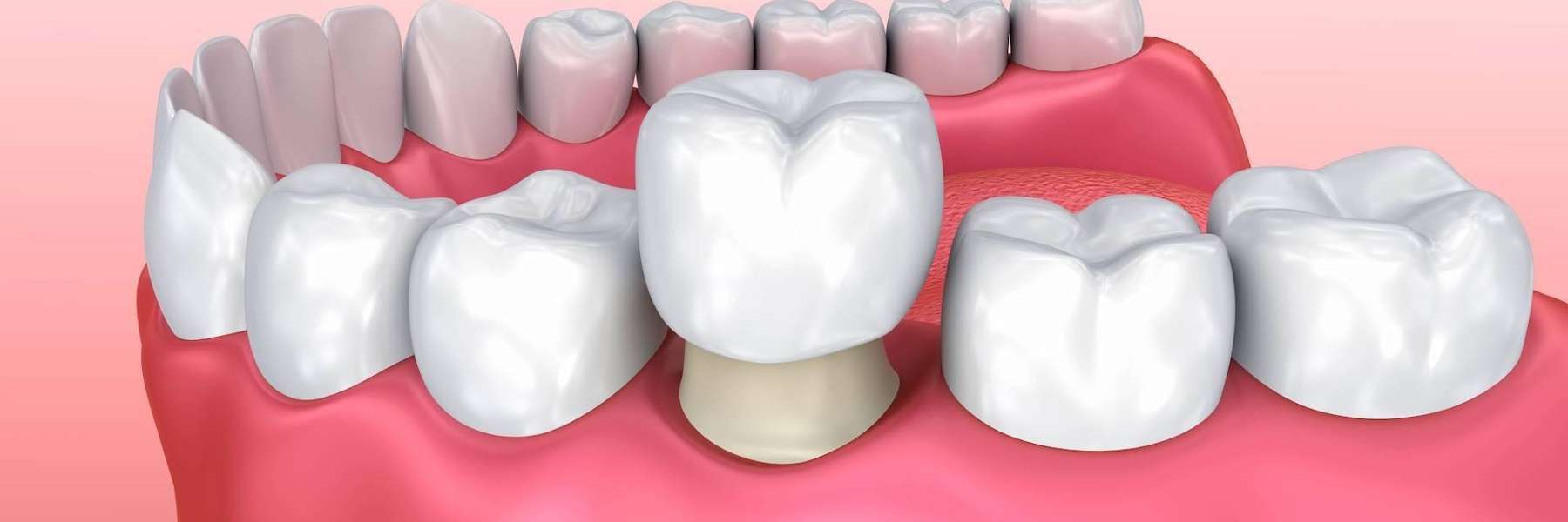Traditional dental crowns in Bonita Springs