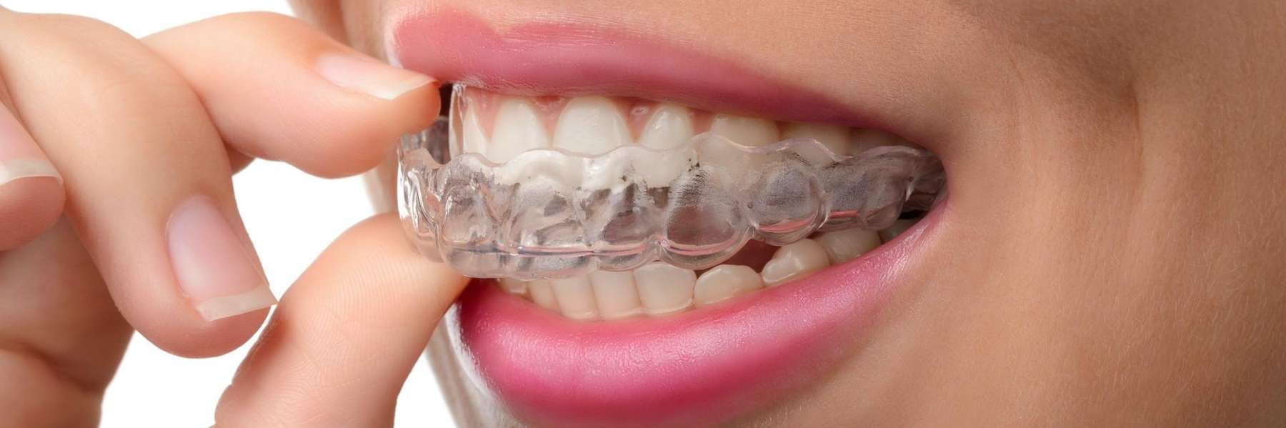 woman putting on her Invisalign clear braces in bonita springs fl