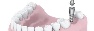 Dental implant screw and abutment parts in Bonita Springs FL