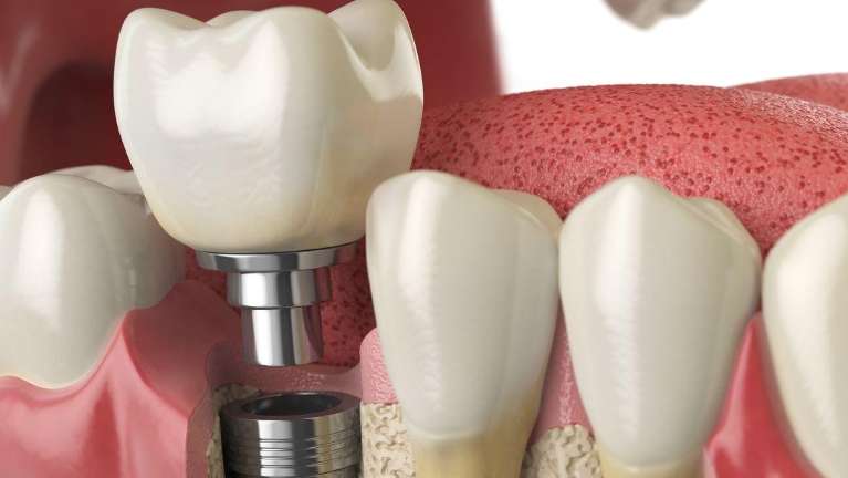 Dental Implant in Bonita Springs.