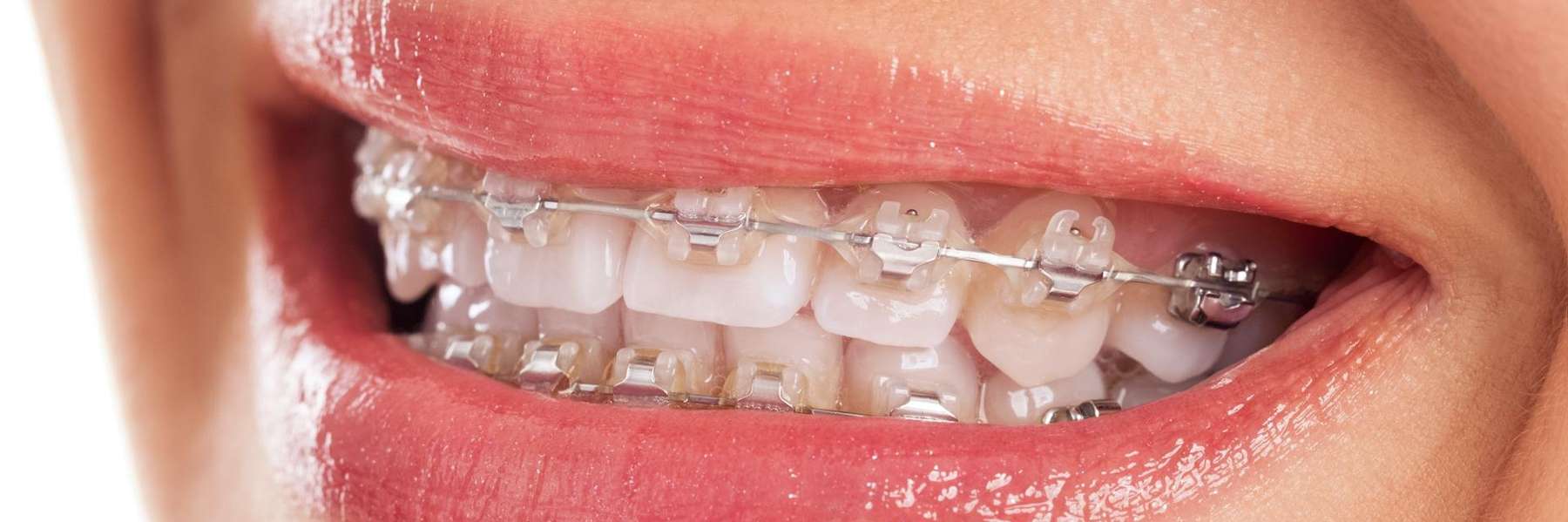 kid with braces in bonita springs