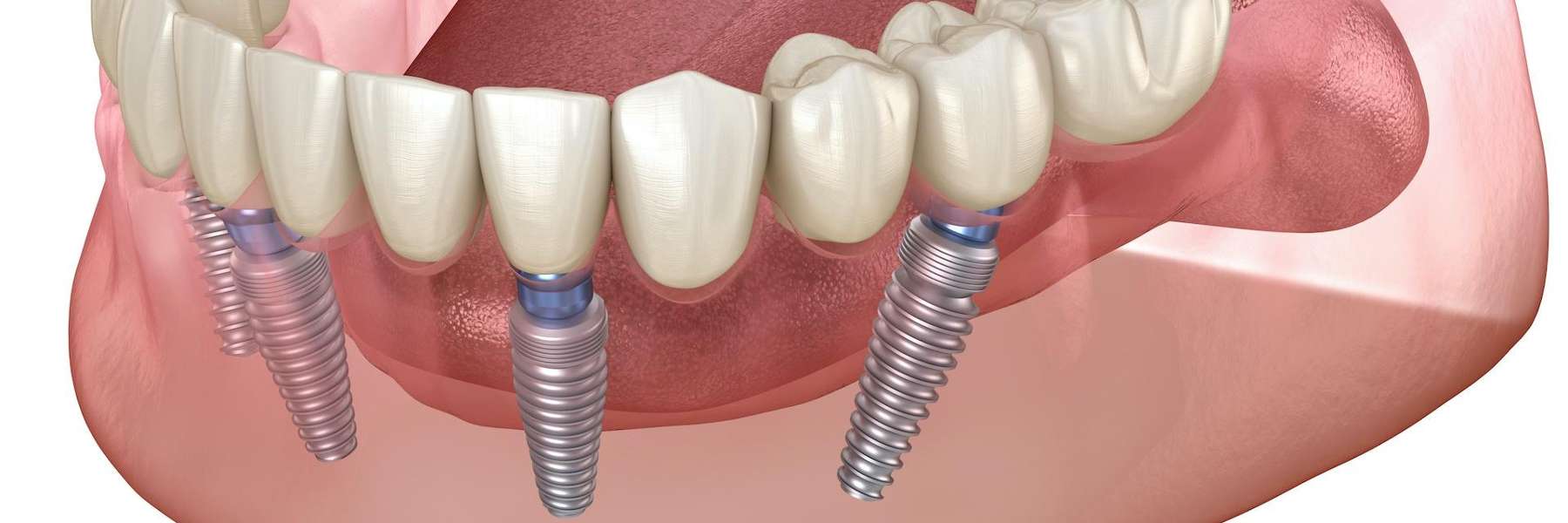 image of dental implants in bonita springs