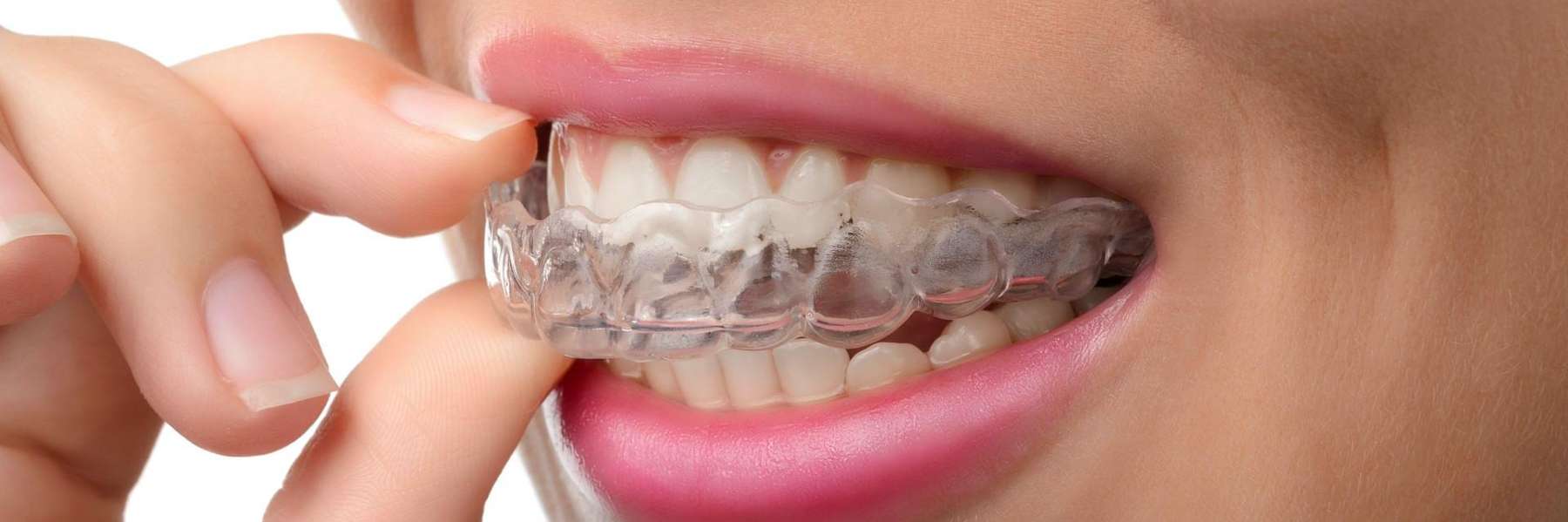 young woman putting on her clear aligners in bonita grande