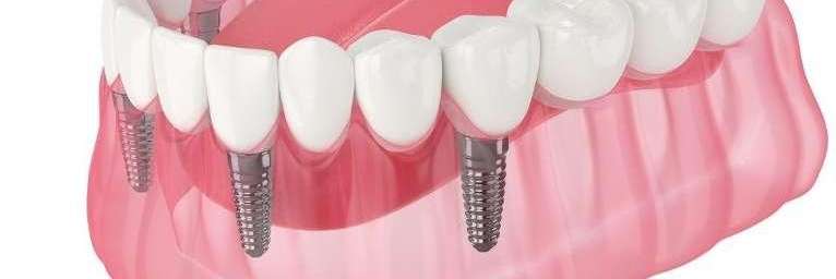Dental implants in Bonita Springs FL