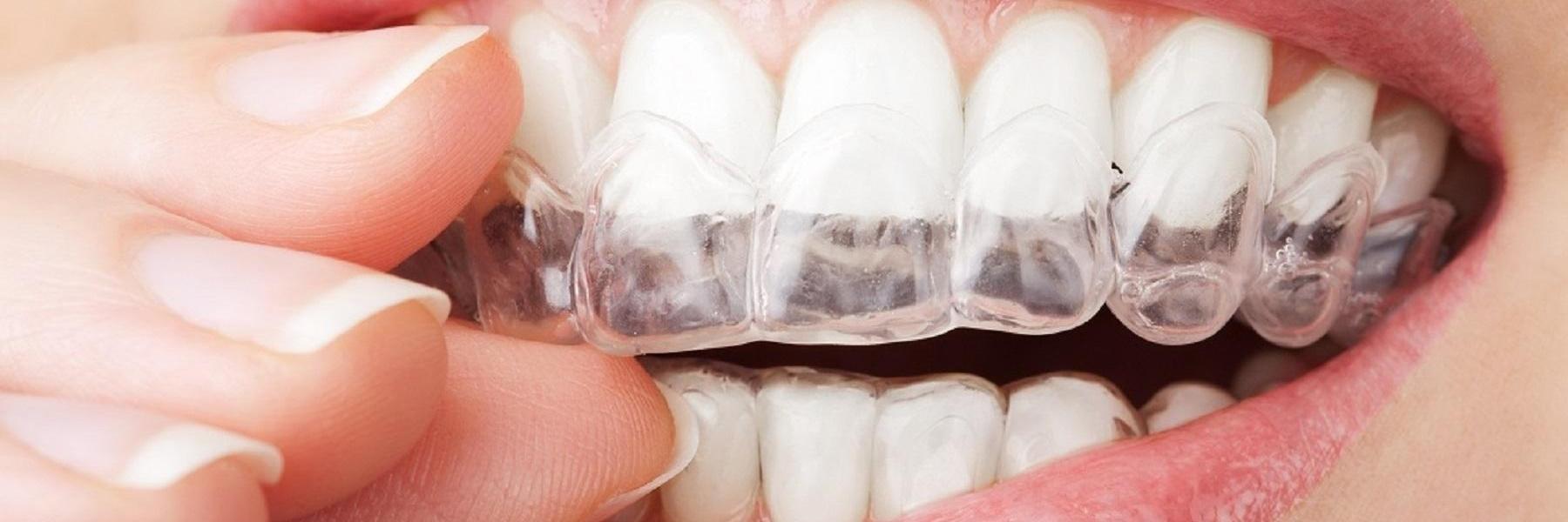 Bonita Springs Dental Blog Invisalign & Veneers Straighten Teeth