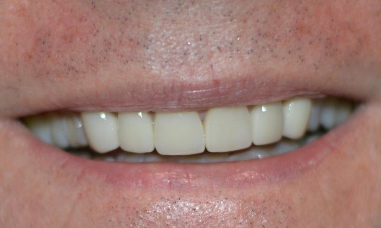 Teeth after dental crown procedure in Bonita Springs Florida