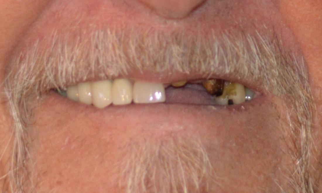 Patient with missing teeth before dental crowns in Bonita Springs, FL
