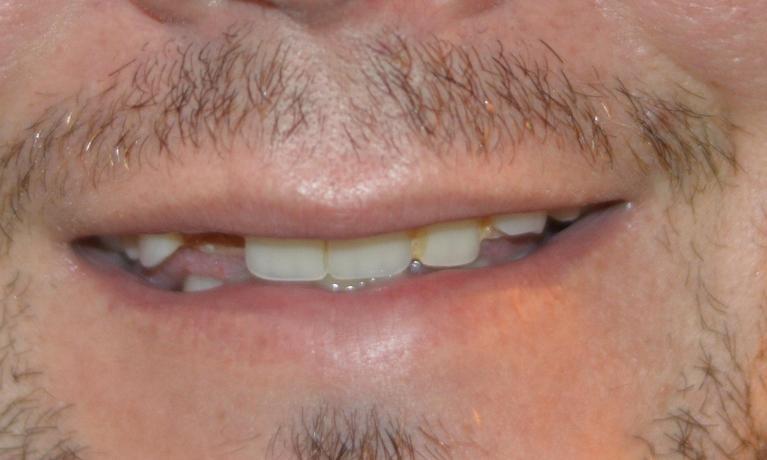 Close up of dental patient with missing teeth at Bonita Grande Dental