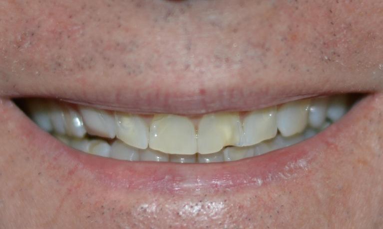 Close up of teeth before dental crowns in Bonita Springs