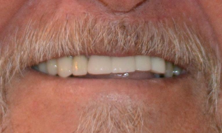 A-Beautiful-Smile-Restoration-After-Image