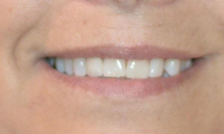 Smile after dental crowns in Bonita Springs, FL