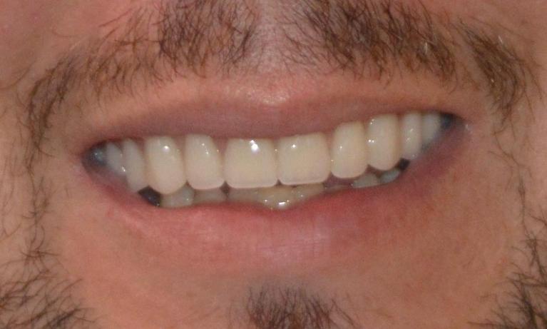 A-Patient-s-Smile-Restored-With-A-Full-Upper-Denture-After-Image