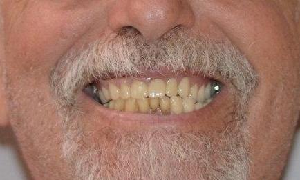 Full-Upper-Denture-After-Image
