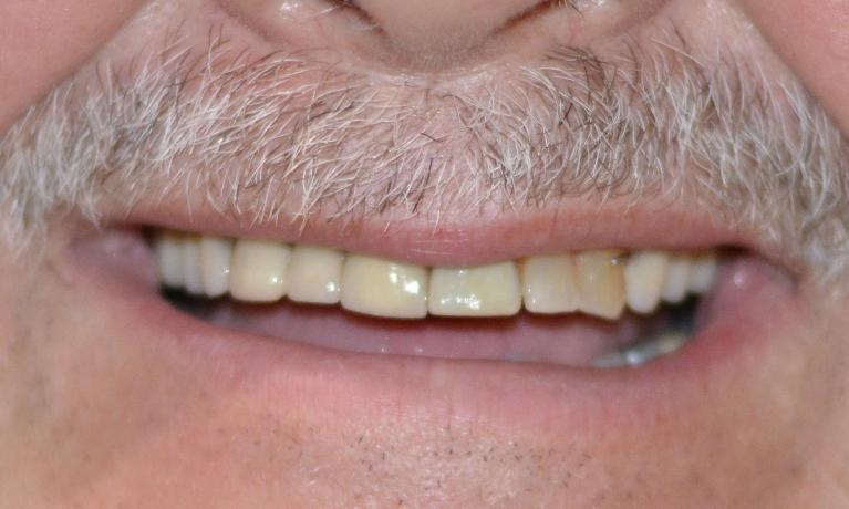 We-Revitalized-This-Patient-s-Smile-With-Crowns-And-A-Partial-Denture-After-Image