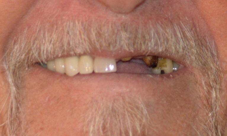 A-Beautiful-Smile-Restoration-Before-Image