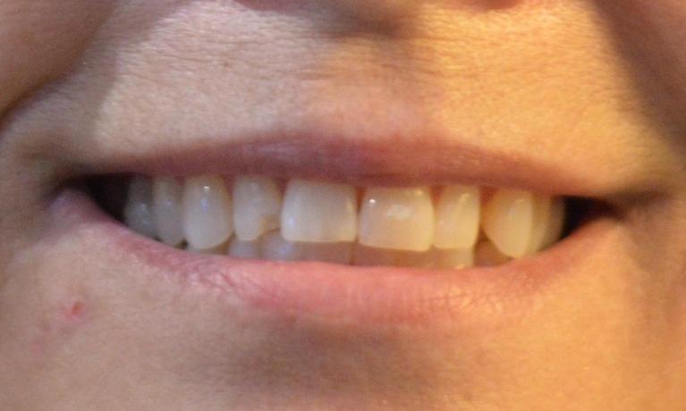 Smile before dental crown procedure in Bonita Springs, FL