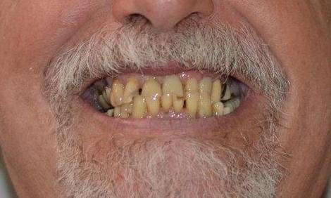 Full-Upper-Denture-Before-Image