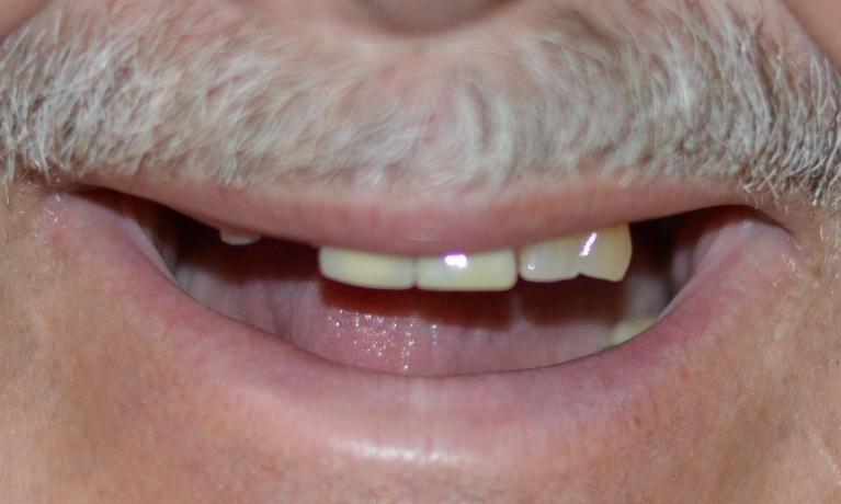 We-Revitalized-This-Patient-s-Smile-With-Crowns-And-A-Partial-Denture-Before-Image